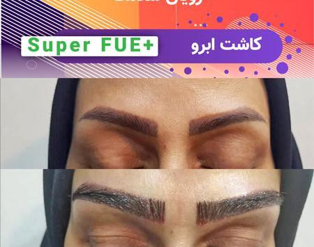 عکس کاشت ابرو بعد از یکسال