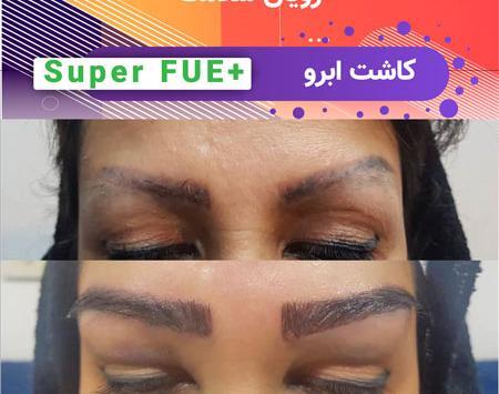 عکس کاشت ابرو بعد از یکسال