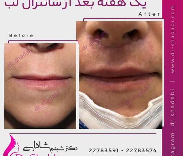 عکس لیفت لب