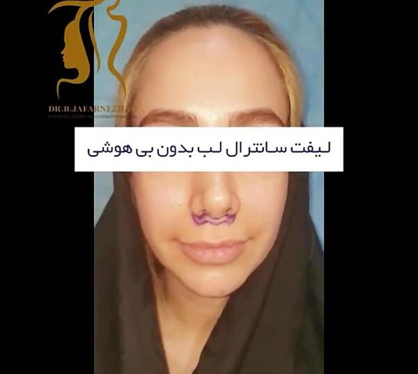 عکس لیفت لب