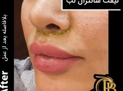 عکس لیفت لب