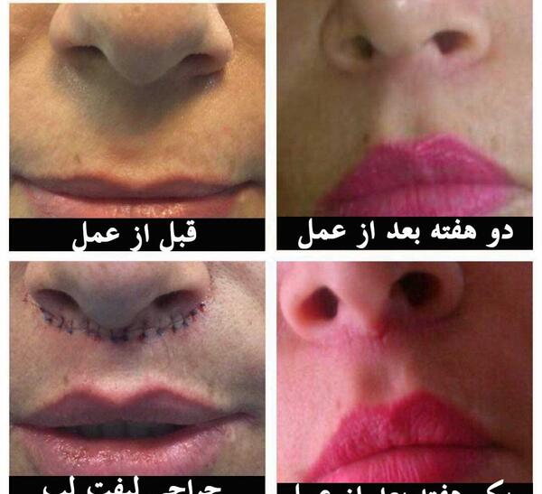 عکس لیفت لب