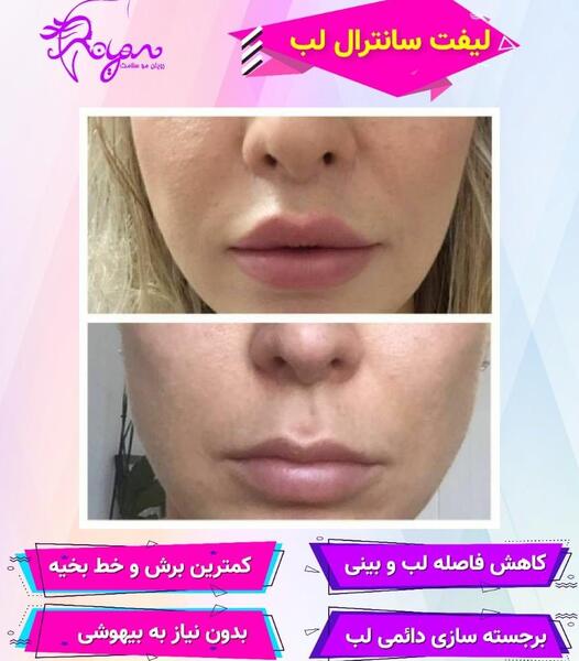 عکس لیفت لب