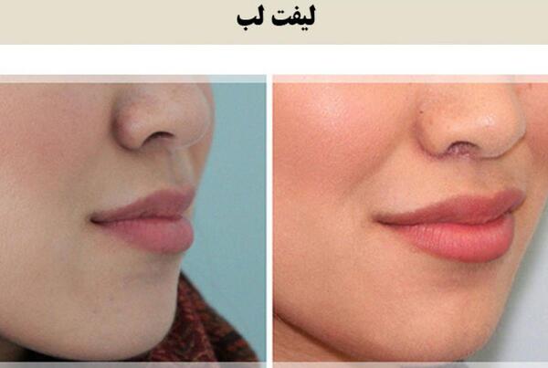 عکس لیفت لب