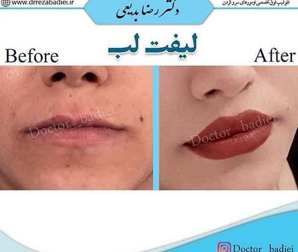 عکس لیفت لب