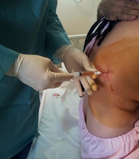 عکس عمل ریه