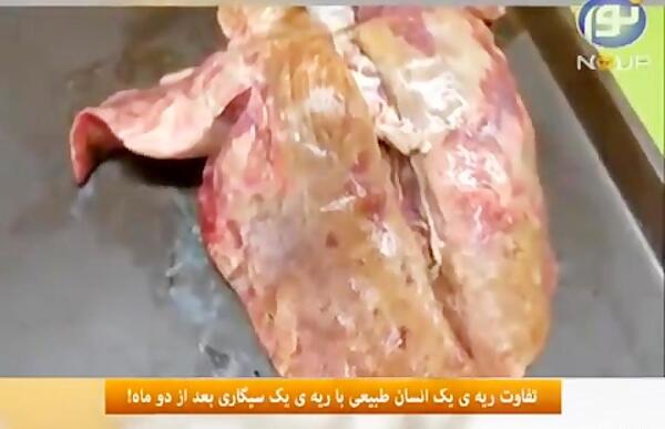 عکس ریه واقعی انسان