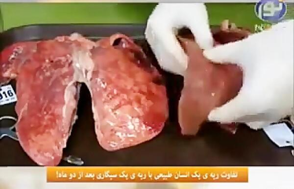 عکس ریه واقعی انسان