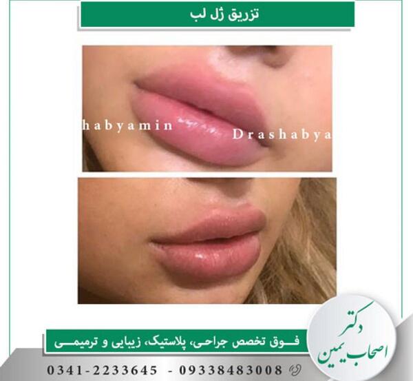 عکس لب پروتز
