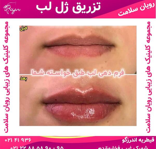 عکس لب پروتز