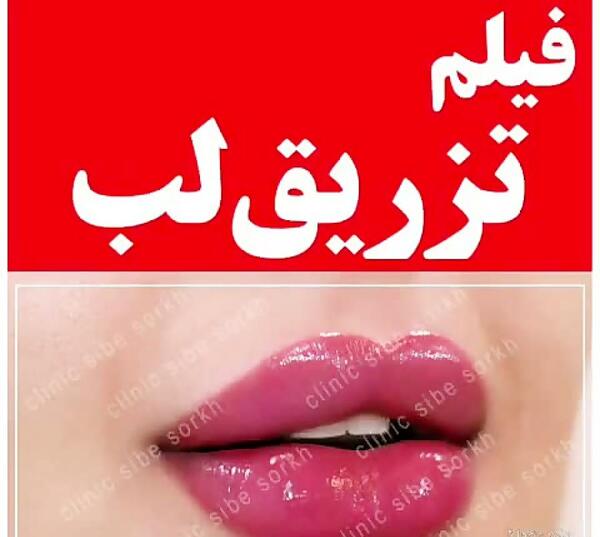 عکس لب پروتز