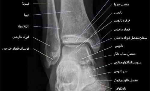 عکس ام ار ای مچ پا