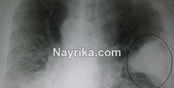 عکس تومور ریه