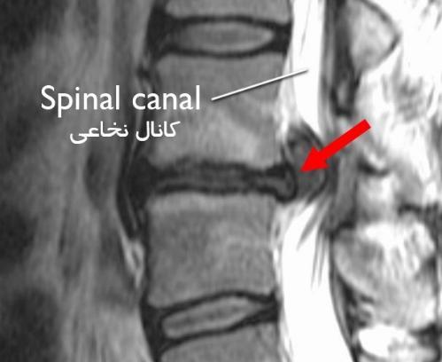 عکس ام ار ای فتق دیسک کمر
