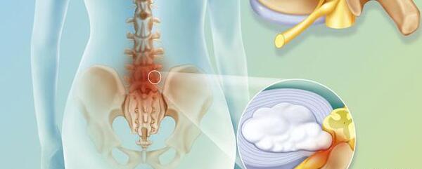 عکس ام ار ای فتق دیسک کمر