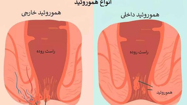 عکس واقعی روده انسان