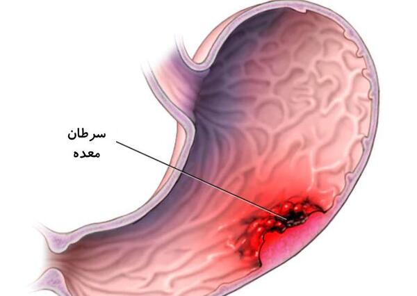 عکس واقعی روده انسان