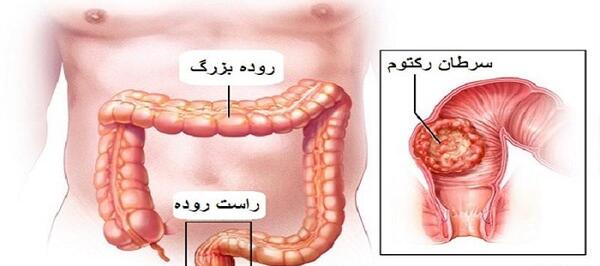 عکس واقعی روده انسان