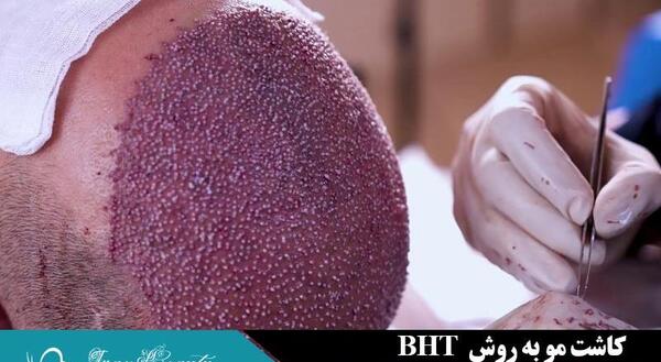 عکس عمل کاشت مو
