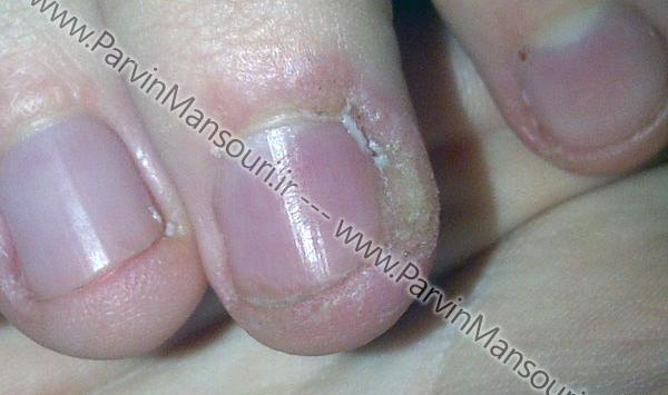 عکس ناخن عفونت کرده