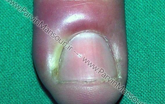 عکس ناخن عفونت کرده