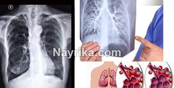 عکس ریه مبتلا به برونشیت