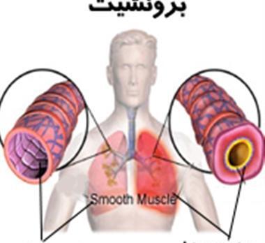 عکس ریه مبتلا به برونشیت