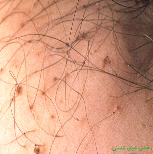 عکس شپش تناسلی زنان