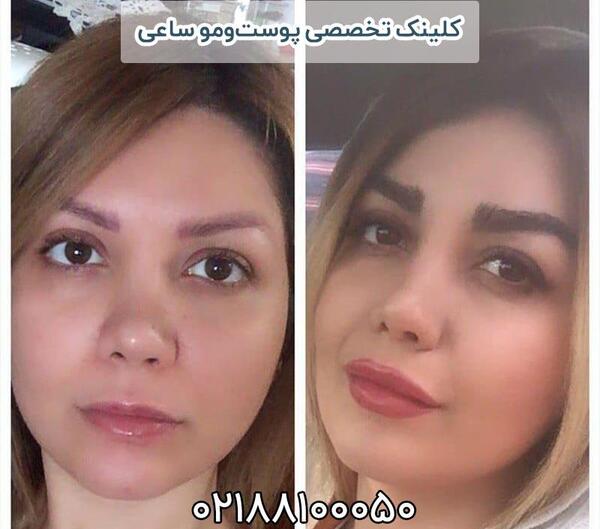 عکس کاشت ابرو نی نی سایت