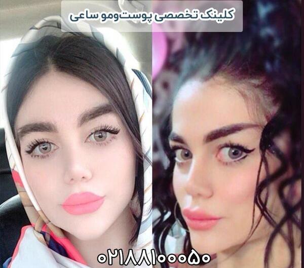 عکس کاشت ابرو نی نی سایت