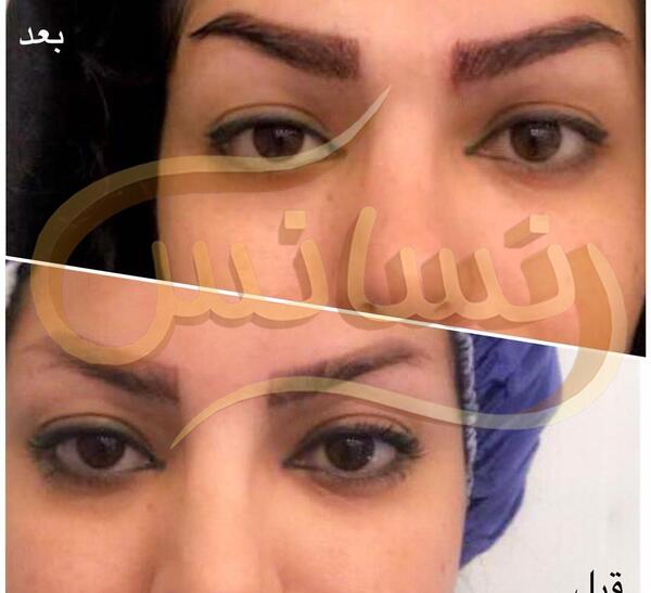 عکس کاشت ابرو نی نی سایت