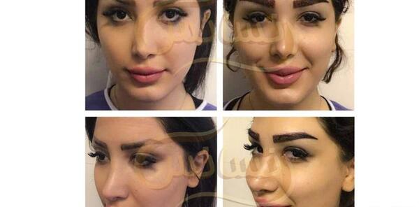 عکس کاشت ابرو نی نی سایت