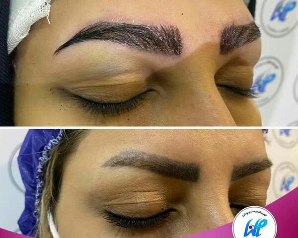 عکس کاشت ابرو نی نی سایت