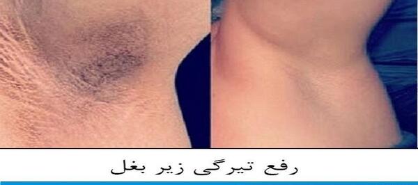 عکس لیزر موهای زیر بغل