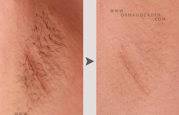 عکس لیزر موهای زیر بغل