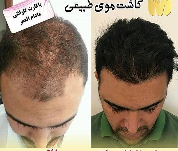 عکس کاشت مو