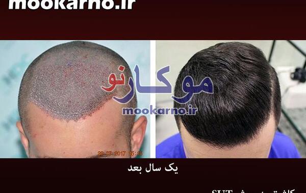 عکس کاشت مو