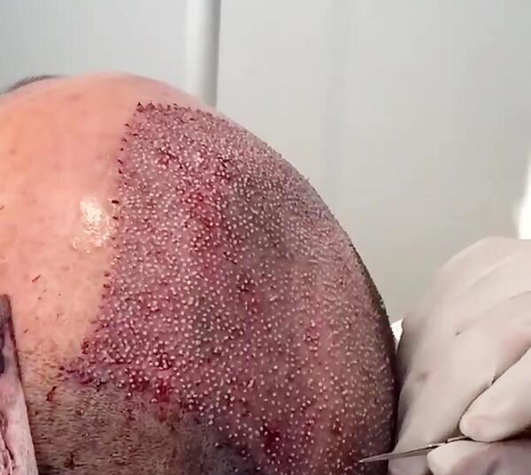عکس کاشت مو
