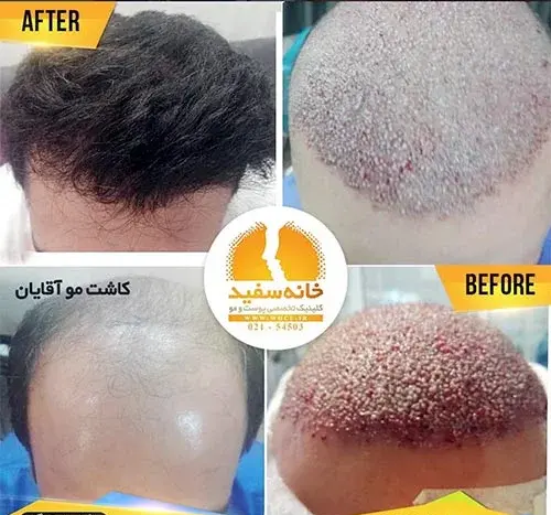عکس کاشت مو
