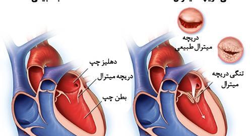 عکس دریچه قلب انسان