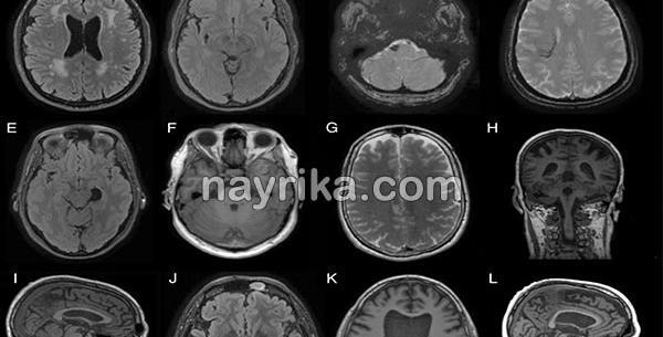 عکس ام ار ای طبیعی مغز