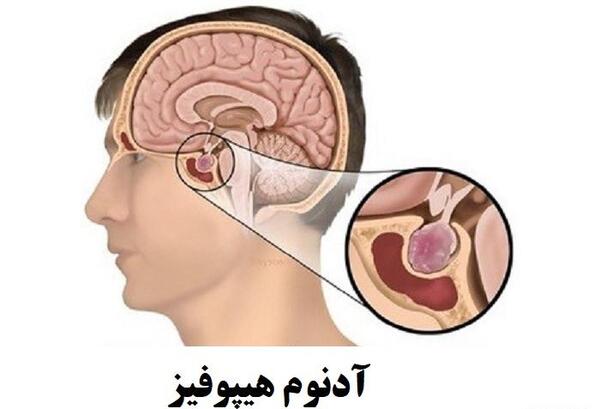 عکس ام ار ای هیپوفیز