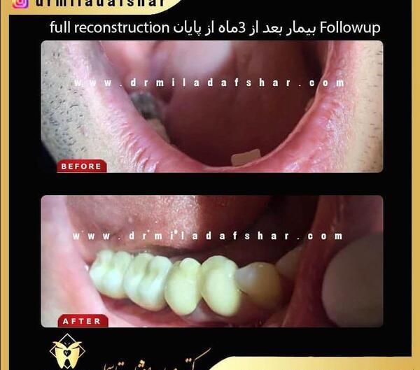 عکس کاشت دندان