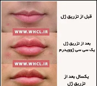 عکس لب ژل زده یک سی سی