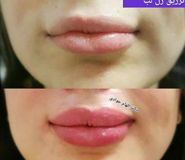 عکس لب ژل زده یک سی سی