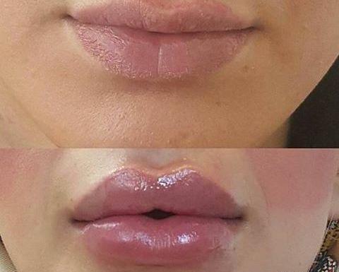عکس لب ژل زده یک سی سی