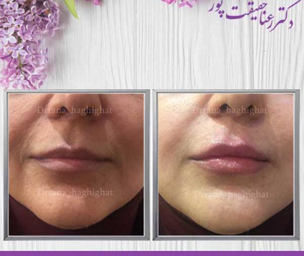 عکس لب ژل زده یک سی سی
