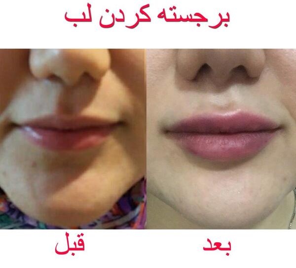 عکس لب ژل زده یک سی سی