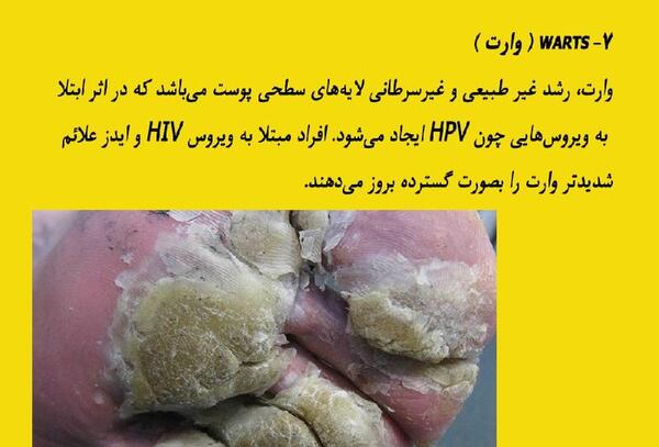 عکس ویروس اچ ای وی
