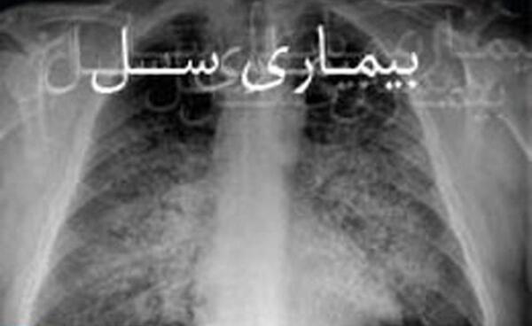 عکس ریه فرد مبتلا به سل